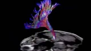 Brain Fiber Tractography [upl. by Nagel]