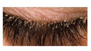 We all have mites in the eyelashes and heres how to get rid of them [upl. by Corliss778]