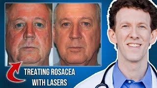 How Can Lasers Help Rosacea [upl. by Marvin]