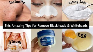 Easy to remove blackheads and whiteheads 🤯  Nose blackheads blackheads remove  whiteheads removal [upl. by Carmina]