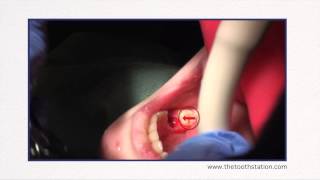 Ankylosis of Primary Tooth  The Tooth Station [upl. by Repotsirhc871]