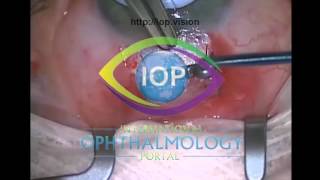 Trabeculectomy Step by Step Part 3 Preview [upl. by Nhguahs]