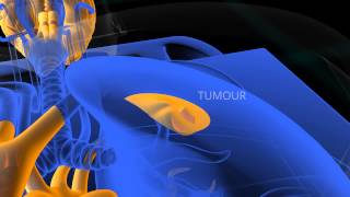 PET Scan animation [upl. by Skiest]