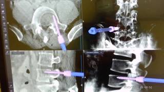 Right L45 Endoscopic TLIF [upl. by Oiramaj]