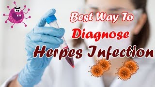 IgG Test For Herpes  Best Way To Figure Out If You Have Herpes [upl. by Kassia294]