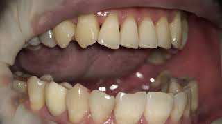 左上植牙 咬合調整 occlusal adjustment  equilibration [upl. by Noryahs]