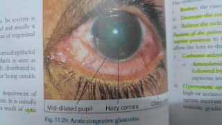 Acute Primary Angle Closure Glaucoma  EYE [upl. by Irap473]