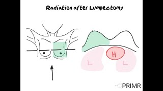 Radiation After Lumpectomy for Breast Cancer [upl. by Peh]