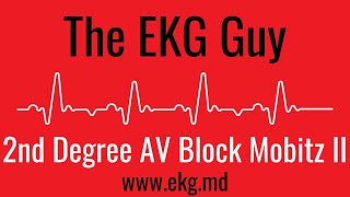 Second Degree AV Block Mobitz II EKG l The EKG Guy  wwwekgmd [upl. by Enneirdna35]