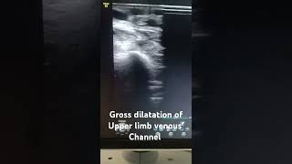 ultrasonography color doppler radiology anatomy case presentation [upl. by Vidovik668]