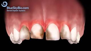 Patient Treatment Videos Veneer Gingivectomy [upl. by Basilius]