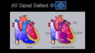 Fetal Echocardiography AV Canal Defect [upl. by Lleira]