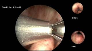 Urolift 2 implant case [upl. by Lanrev]