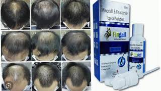 FINGAIL SOLUTION Fingail Hair Regrowth Treatment Minoxidil amp Finasteride Topical Solution [upl. by Angeline314]