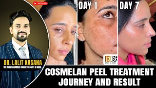 COSMELAN PEEL TREATMENT JOURNEY AND RESULT DAY 1 TO DAY 7 [upl. by Gordy475]