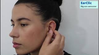 Protruding ear corrector EARCLIC [upl. by Gough]