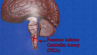 Wallenberg syndrome  Lateral medullary syndrome  posterior inferior cerebellar artery syndrome [upl. by Arhez]