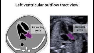 Left Ventricular Outflow Tract View 119 [upl. by Lawlor]