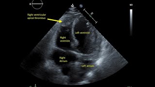 Case 140  Right ventricular thrombus [upl. by Littman664]