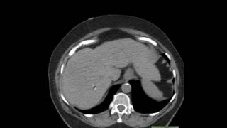 CT Abdomen Epiploic Appendagitis and anatomy [upl. by Hollington]