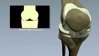 Meniscus Tears [upl. by Shyamal]