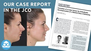 Our case report in the Journal of Clinical Orthodontics [upl. by Suired]