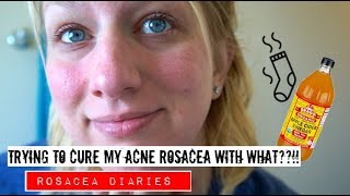 A Natural Treatment For Acne Rosacea  Rosacea Diaries  Trying Apple Cider Vinegar Part 1 [upl. by Zach]