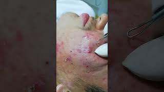 Limpieza facial profunda 2  Extracción de comedonesRemoval of acne pimples and blackheads [upl. by Bal510]