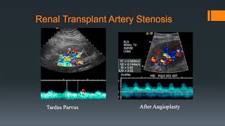 Renal Transplants [upl. by Llecrep]