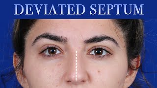 How To Fix A Deviated Septum  Dr Moustafa Mourad  Mourad NYC [upl. by Sirref]