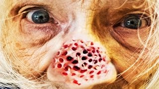 Worlds Worst Trypophobia What is Trypophobia Cysts Acne Makeup Pimples Documentary Censored [upl. by Zetneuq160]