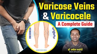 Varicose Veins amp Varicocele Symptoms and Best Treatment Methods in Hindi By Dr Amol Lahoti [upl. by Germin]