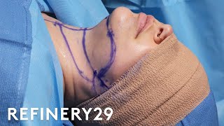 Double Chin Removal Surgery  Macro Beauty  Refinery29 [upl. by Viscardi]