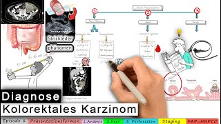 kolorektales Karzinom Ep 13 DIAGNOSE [upl. by Drahnreb]