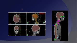 Treatment Planning of CSI [upl. by Kalil133]