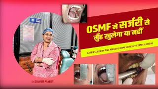 OSMF मे सर्जरी से मुँह खुलेगा या नहीं  Laser surgery and manual OSMF surgery complications [upl. by Issej549]