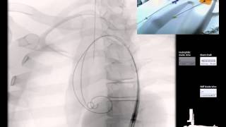 Mentice  Thoracic Endovascular Aortic Repair TEVAR Case Video [upl. by Lasky579]