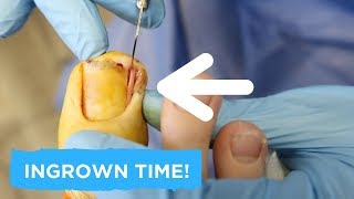 SNIP SNIP  Cutting out an Ingrown and Excess Tissue [upl. by Saerdna]