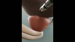 RobotAssisted Prostate Resection  animationshorts shortsfeed youtubeshorts viralshorts [upl. by Oderf]