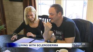 Video Living with scleroderma [upl. by Dibb330]