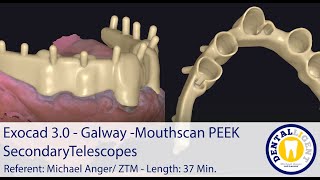 2021Exocad  Tutorial PreviewExocad 30 – Galway Mouthscan PEEK Secondary Telescopes [upl. by Amirak145]