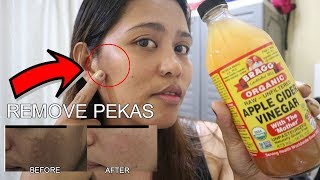 PAANO MATANGAL ANG PEKAS O MELASMA GAMIT ANG APPLE CIDER VINEGAR TIPID AT NATURAL NANPARAAN [upl. by Goddard139]