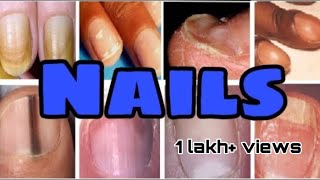 Nails disorders  Nails diseases and differential diagnosis  MisMedicine [upl. by Arraes]