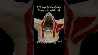 Tamanho Incisão Cirurgia Ortognática Maxila cirurgiaortognática minimamenteinvasiva [upl. by Nigel]