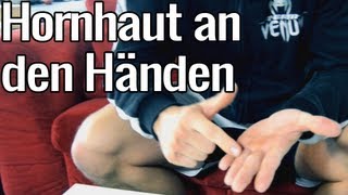 Hornhaut an den Händen behandeln [upl. by Joye]