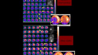 Myocardial Perfusion Imaging NMINE India [upl. by Artenak99]