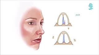 Rhinoplasty Information  High speed [upl. by Coussoule]