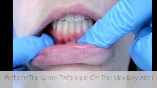 Measuring for Minimally Attached Gingiva [upl. by Ardni]