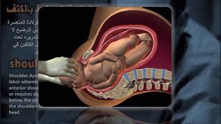 shoulder dystocia l عسر ولادة الكتف [upl. by Eelarak]