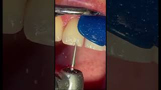 Fixing chipped tooth with composite bonding at the dentist [upl. by Sunderland]